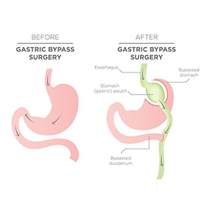 What Happens if I Gain Weight Back After Gastric Bypass? Revision Solutions in the Chicago...