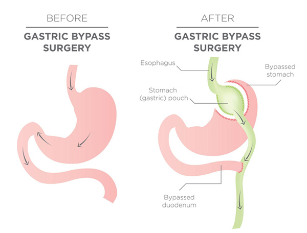 What Happens if I Gain Weight Back After Gastric Bypass? Revision Solutions in the Chicago Suburbs